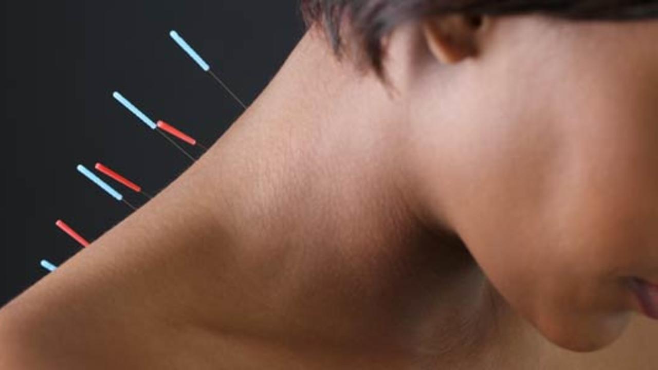 acupuncture needles on women's neck