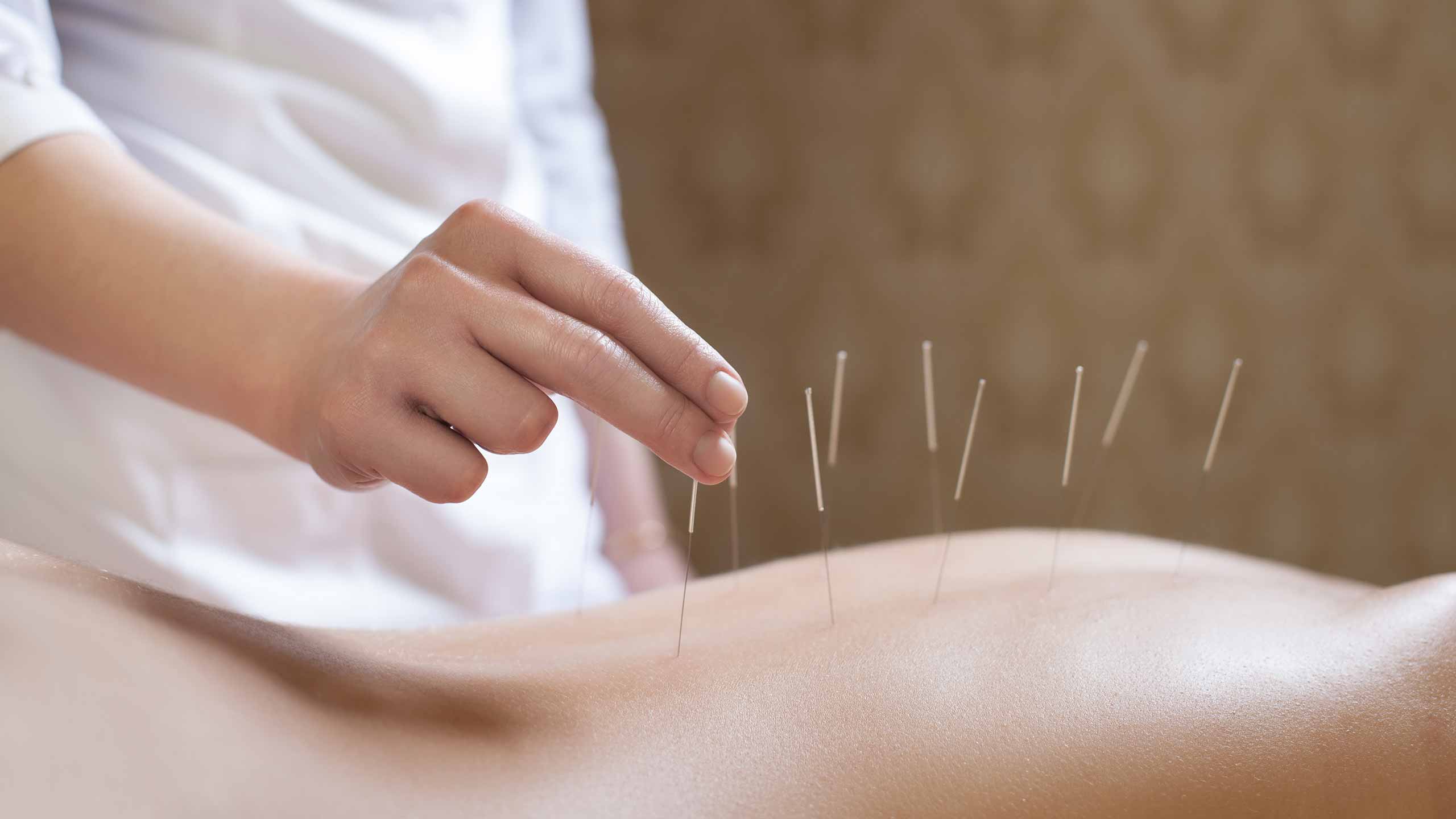 Acupuncturist’s hand  adjusting needles on the back of patient